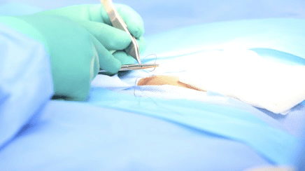 Open hernia repair