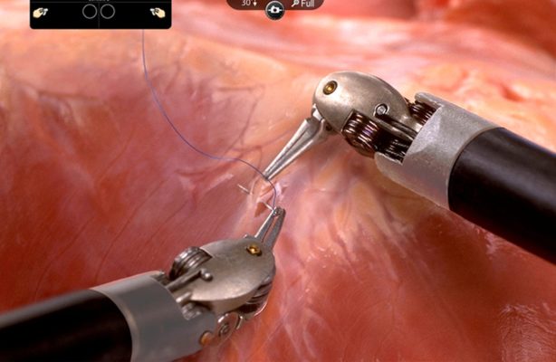 Robotic and laparoscopic repairs