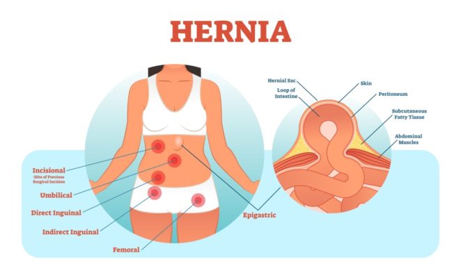 Umbilical and ventral hernia