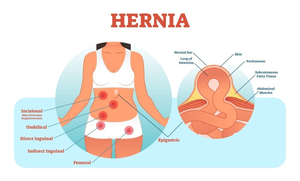 How To Tell If You Have Diastasis Recti Or A Hernia