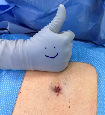 Umbilical Hernias – The Case for No-Mesh Repairs
